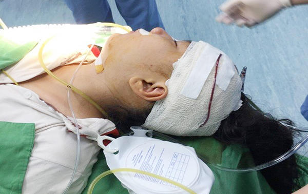 Cấp cứu nữ sinh lớp 5 bị kéo găm vào đầu 3cm khi chơi đùa