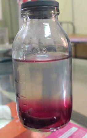 Gắp thành công con đỉa 10cm kí sinh trong cơ thể cháu bé 11 tuổi