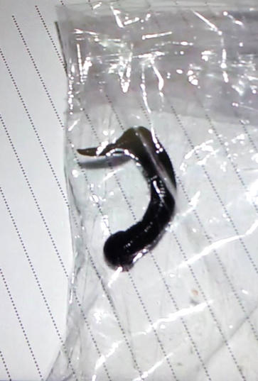 Gắp thành công con đỉa 10cm kí sinh trong cơ thể cháu bé 11 tuổi