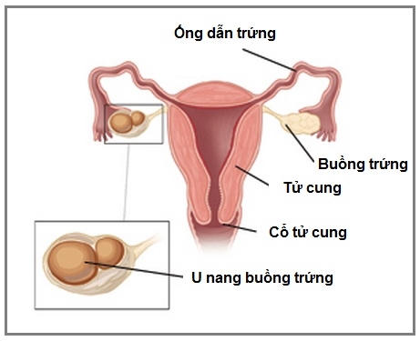Cảnh báo những bệnh gây đau bụng dưới ở phụ nữ