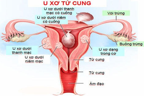 Cảnh báo những bệnh gây đau bụng dưới ở phụ nữ