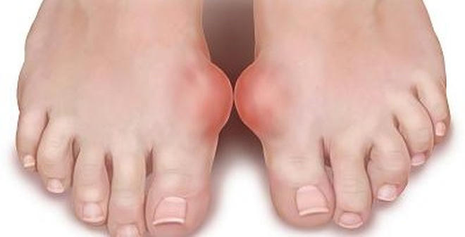 Nỗi ám ảnh về căn bệnh gút