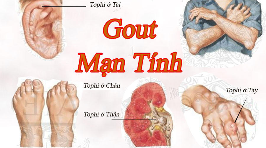 Nỗi ám ảnh về căn bệnh gút