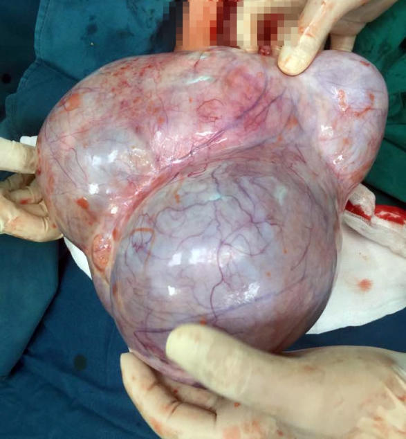 Cắt khối u buồng trứng nặng 4kg cho người phụ nữ nghèo