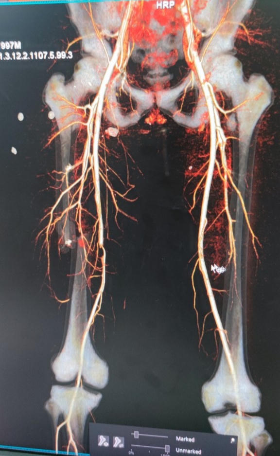 Mổ cứu chân trong tình trạng hiếm gặp cho bệnh nhân bị ô tô đâm