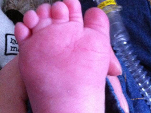 Bé trai có 12 ngón chân, 12 ngón tay