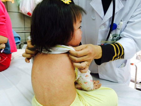 5 trẻ tử vong vì biến chứng bệnh sởi