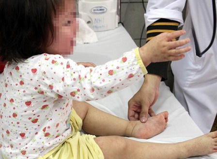 Bùng phát dịch sởi với diễn biến phức tạp