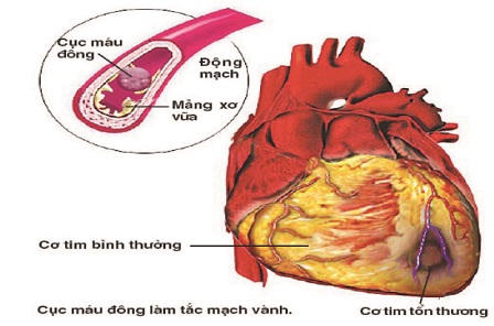 Chế độ dinh dưỡng giảm nhồi máu cơ tim mùa lạnh