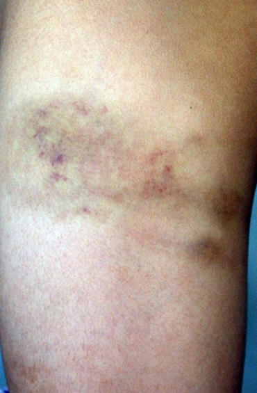 Đình chỉ công tác cô giáo đánh bầm đùi học sinh lớp 2