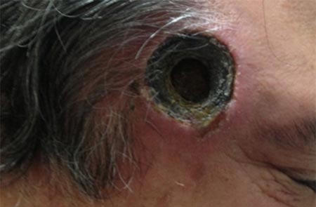 Thủng đầu vì tự tẩy nốt ruồi