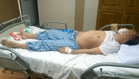 Những thông tin bất ngờ về dịch sởi ở người lớn