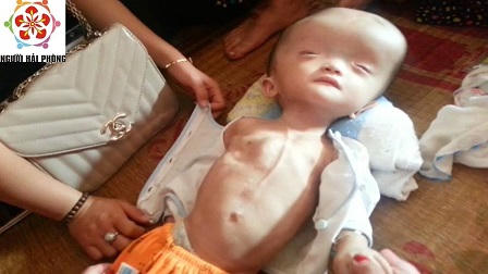 Người mẹ bán cả chó chữa bệnh cho con “dài cổ” đợi tiền từ thiện