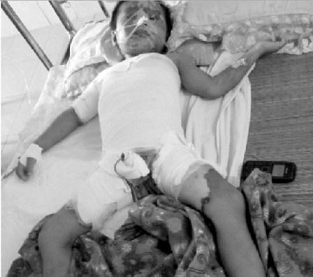 Xót xa bé 3 tuổi bị nước sôi đổ vào người, bỏng 35% cơ thể