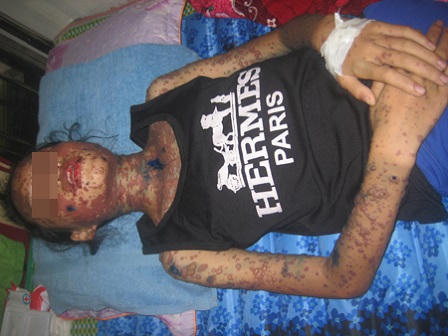 Cứu sống bệnh nhi dị ứng thuốc, bỏng rộp toàn thân