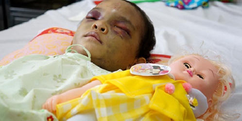 Bác sĩ “sốc” khi điều trị trẻ bị bạo hành gia đình