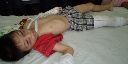 Bác sĩ “sốc” khi điều trị trẻ bị bạo hành gia đình