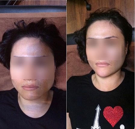 Làm đẹp siêu tốc bằng tiêm thuốc là quá nguy hiểm