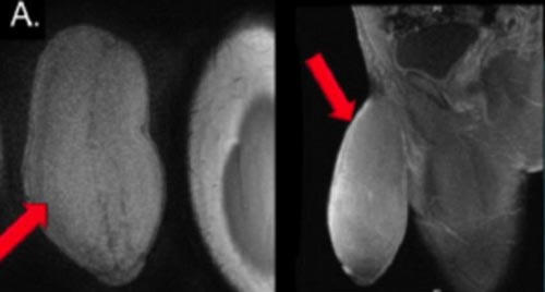 Ca phẫu thuật thu nhỏ “cậu nhỏ” đầu tiên trên thế giới