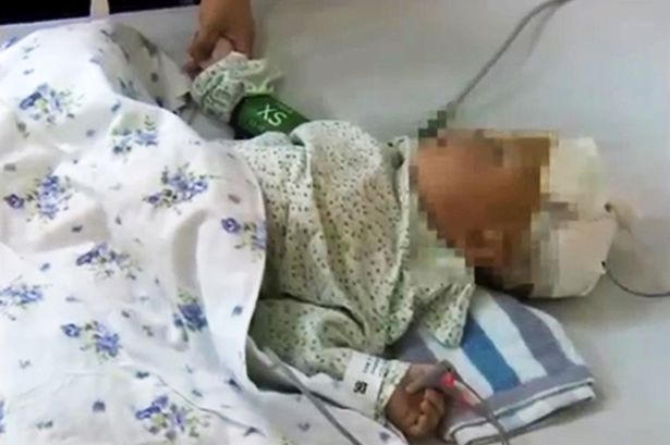 Đũa mắc kẹt trong não suốt 10 ngày vẫn sống sót kỳ diệu