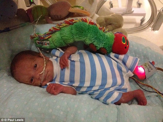 Mẹ vỡ ối từ tuần 18, con vẫn sống sót