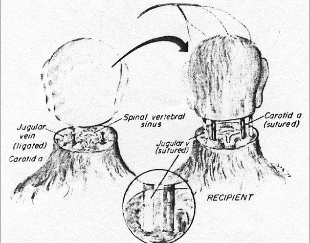 Ca cấy ghép đầu người hy hữu thế giới