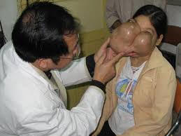  2 khối u khổng lồ đẩy mắt thiếu phụ lên trán