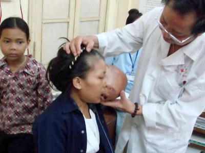  2 khối u khổng lồ đẩy mắt thiếu phụ lên trán