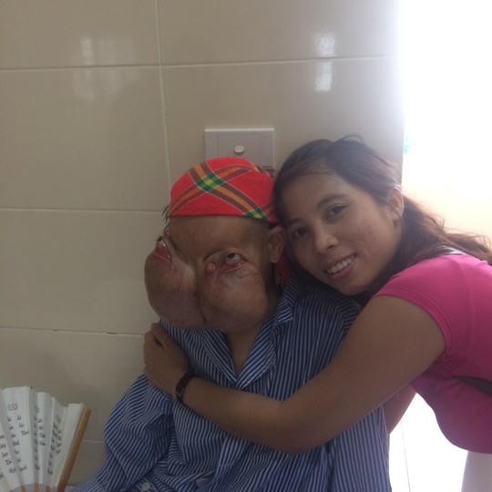  2 khối u khổng lồ đẩy mắt thiếu phụ lên trán