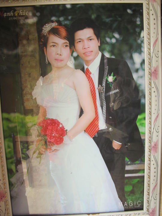  2 khối u khổng lồ đẩy mắt thiếu phụ lên trán