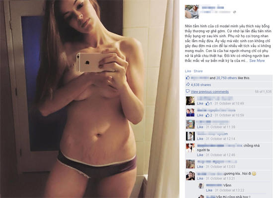 Tâm sự của người đàn ông yêu bụng rạn da của vợ