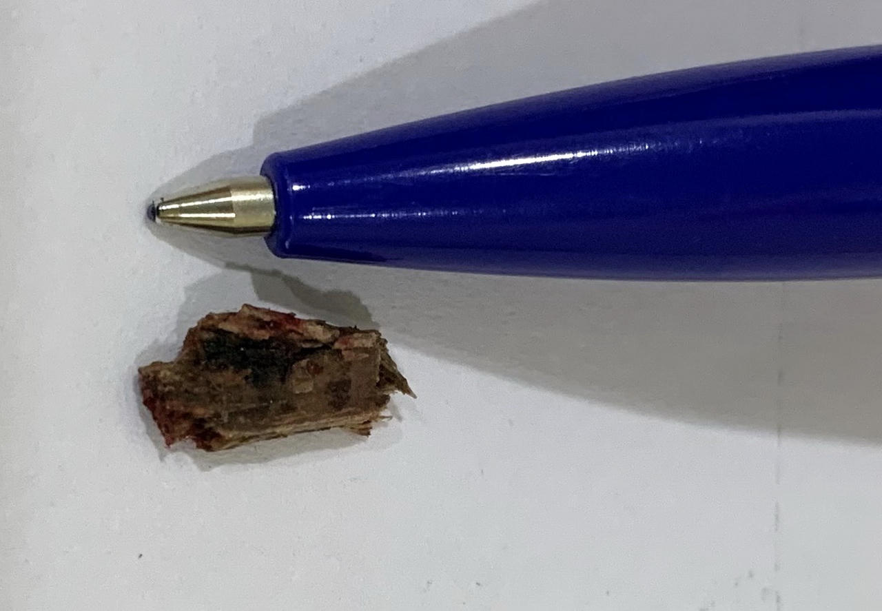 Cứu bệnh nhân ngã xe bị cây đâm rất sâu vùng cổ 