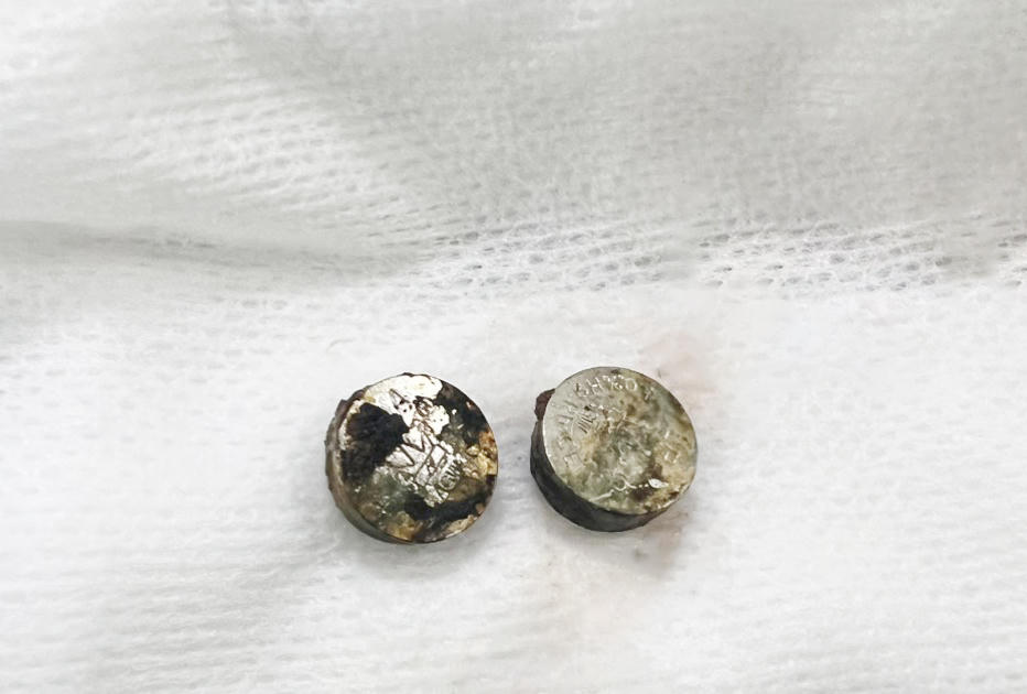 Lấy 2 cục pin cháy khét trong hai lỗ mũi bé gái 6 tuổi