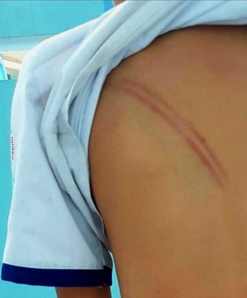 Một học sinh tiểu học ở Cà Mau bị mẹ kế đánh nhiều vết bầm trên người