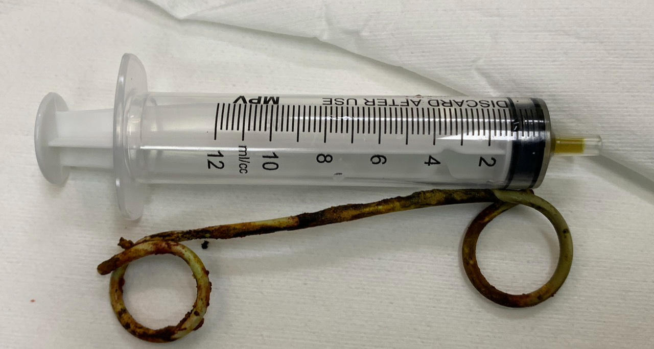 Một stent nhựa dài 15 cm bị bỏ quên trong ống mật cụ bà suốt 6 năm 