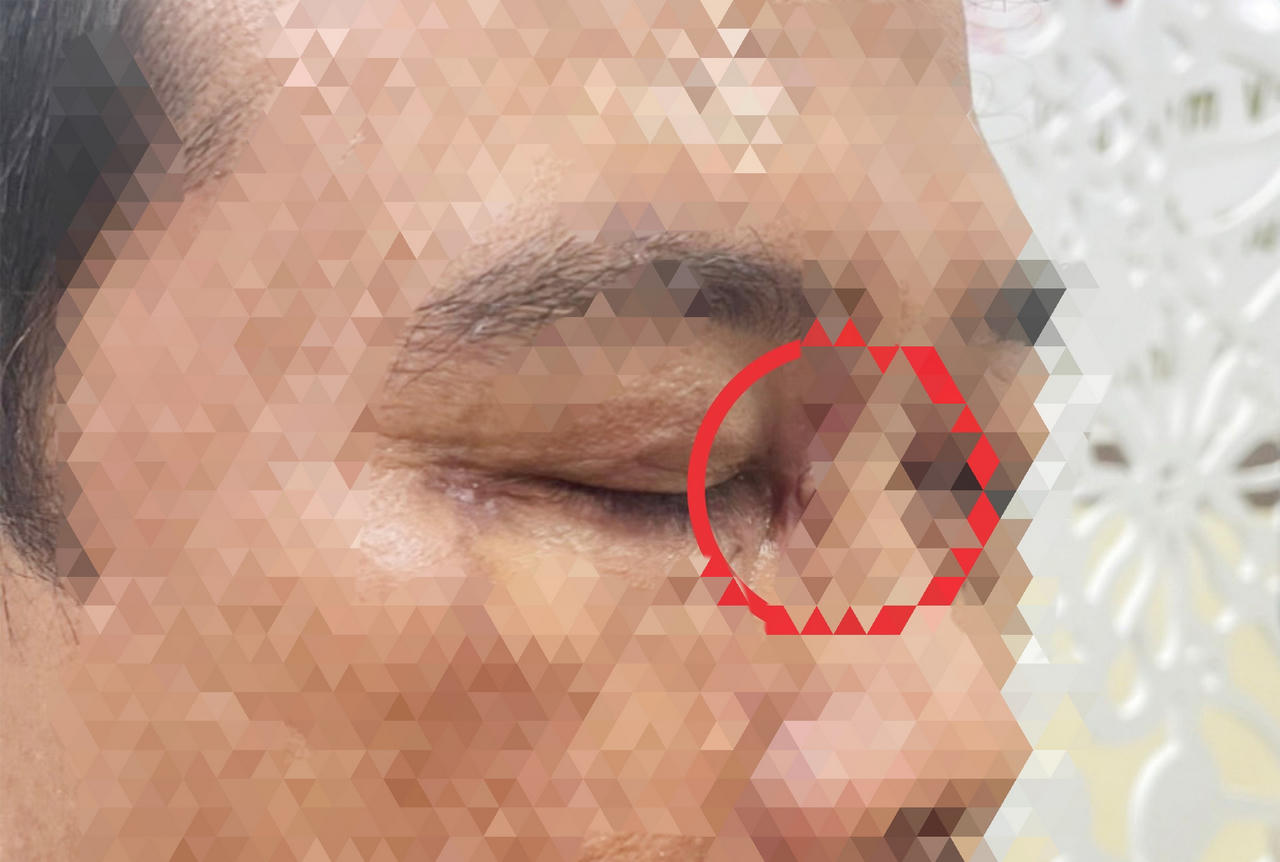 Nhiều mảnh vỡ của tròng kính cận nằm sâu trong mũi người đàn ông ở Bạc Liêu