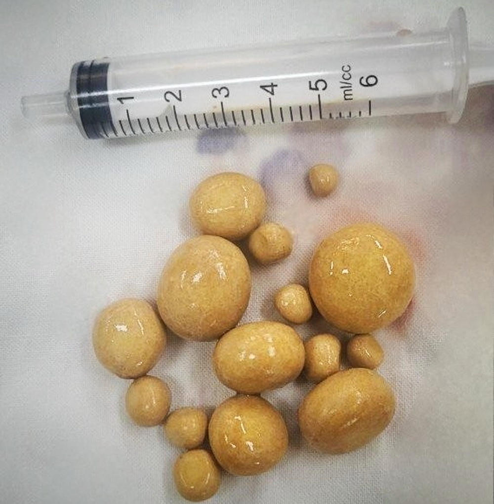 Lấy 15 viên sỏi trong bàng quang của một đàn ông ở Bạc Liêu