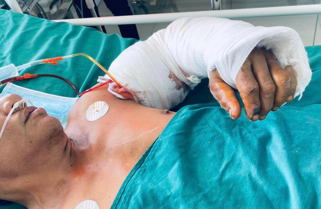 Phẫu thuật ghép nối thành công cánh tay bị đứt lìa