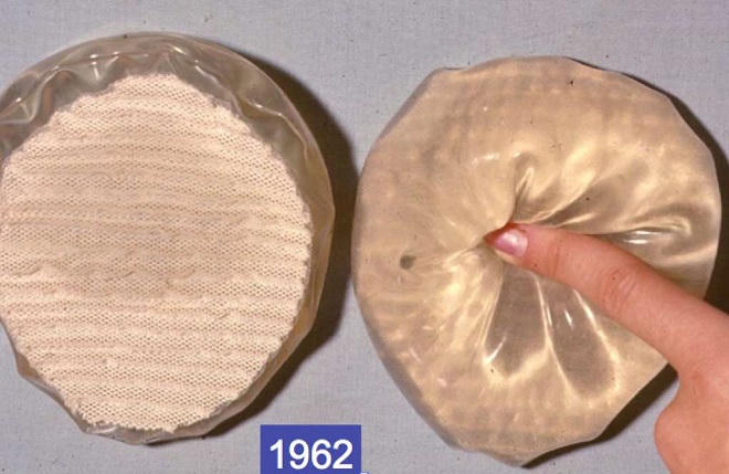 Gặp lại người phụ nữ đầu tiên nâng ngực trên thế giới