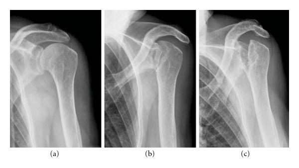Hội chứng “xương biến mất” thách thức y học hiện đại