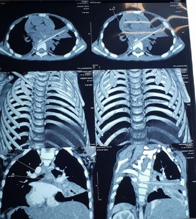 Que xiên thịt nướng là thủ phạm khiến bé 5 tuổi bị viêm phổi