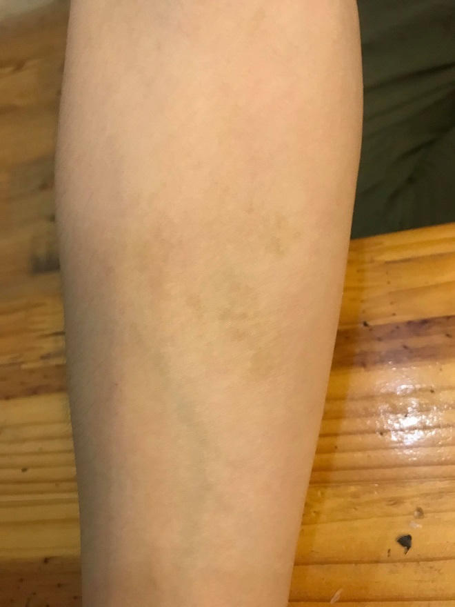 Thiếu nữ 7 năm giành giật sự sống với ung thư gan