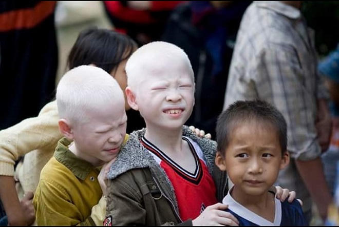 Cặp song sinh mắc bệnh bạch tạng tại Hà Tĩnh trở thành “ngôi sao” mạng xã hội