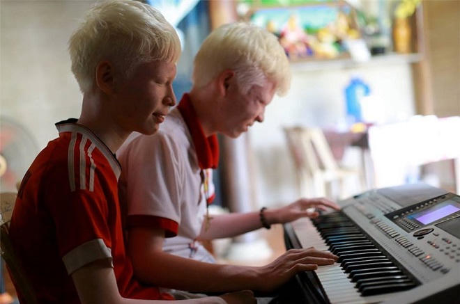 Cặp song sinh mắc bệnh bạch tạng tại Hà Tĩnh trở thành “ngôi sao” mạng xã hội