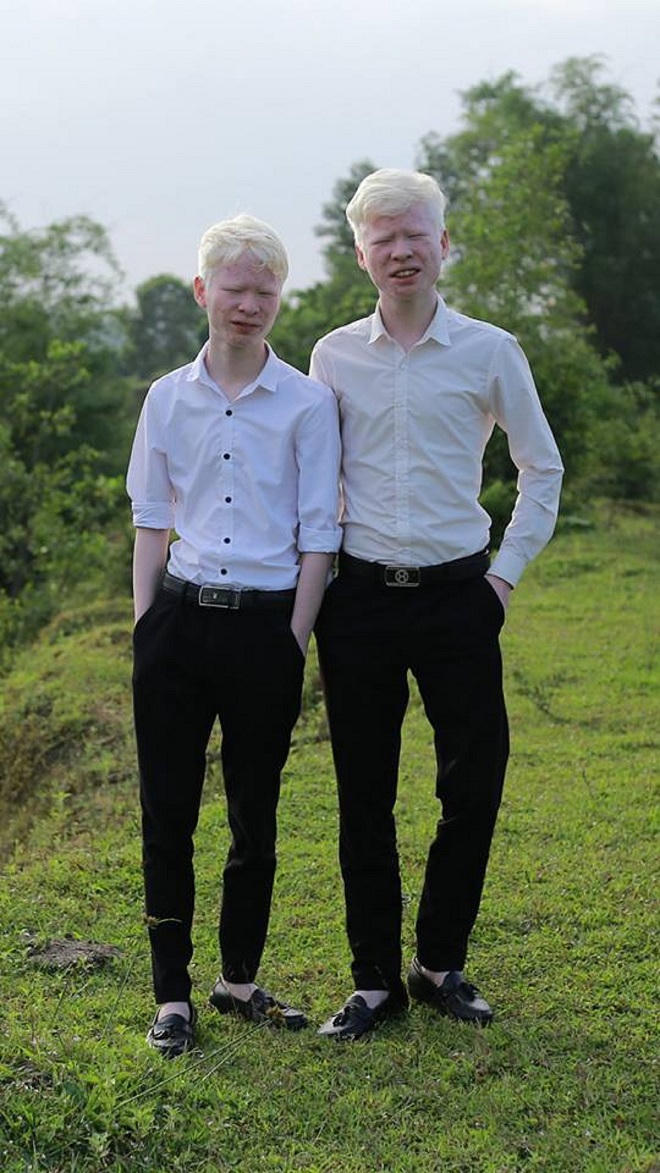 Cặp song sinh mắc bệnh bạch tạng tại Hà Tĩnh trở thành “ngôi sao” mạng xã hội