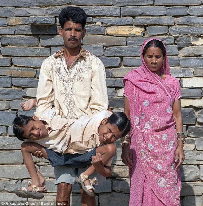 Giải lời nguyền nghiệt ngã, cặp song sinh chung dạ dày khiến thế giới ngỡ ngàng