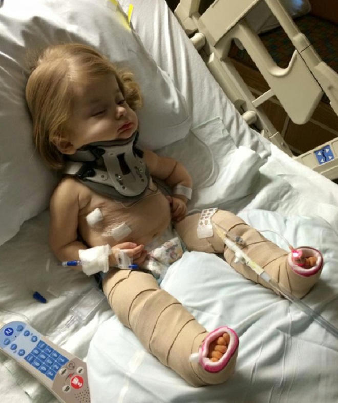 Cô bé hạnh phúc dù cha mẹ không còn muốn đếm số lần gẫy xương