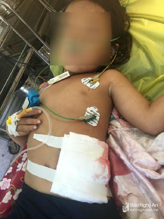 Bé gái 5 tuổi thủng bụng vì lưỡi máy cắt cỏ của ông văng vào