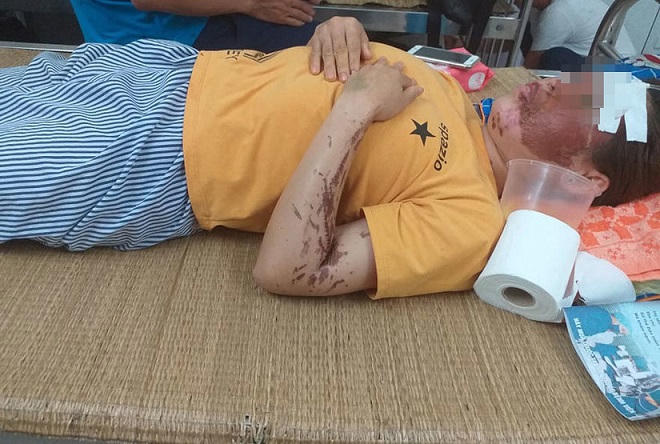 Nữ phụ bếp kể lại giây phút bị tạt axít