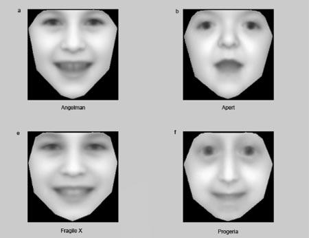 Nét mặt “tố” bệnh di truyền?